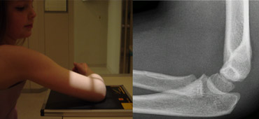 Shoulder higher than elbow. Radius and Capitellum project on to the ulna.