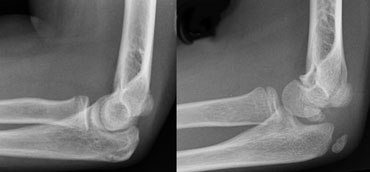LEFT: Slight endorotation of the humerus due to a low position of the wrist. RIGHT: More endorotation due to malpositioning.