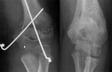 Gartland III fracture with medial-lateral cross pin technique. After reduction there is inadequate correction of medial collaps. After two months there is malunion with cubitus varus deformity.