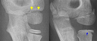 LEFT a subtle lateral condyle fracture. Less than 2 mm displacement and probably stable. RIGHT a different case. Oblique view gives nice impression of fracture. Blue arrow indicates a cleft epiphysis of the radius (normal variant)