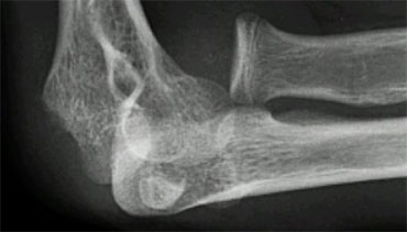 Dislocation of the elbow with interposed medial epicondyle.