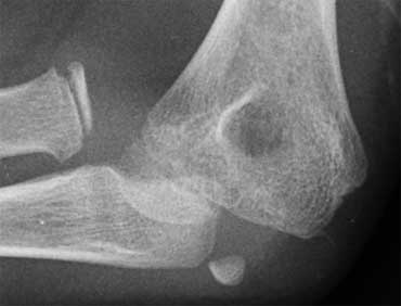 Another example of a dislocated elbow with avulsion of the medial epicondyle. In this case the epicondyle is not retracted into the joint.