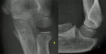 Subtle radial neck fracture seen only on AP-view.