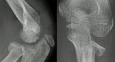 Radial neck fracture with tilt. Notice trochlear ossifications projecting in between humerus and ulna simulating intra-articular fragments.