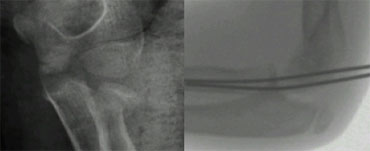 After closed reduction radiograph in cast shows unsuccesfull reduction. K-wire insertion is performed