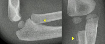 The radial epiphysis is slipped (arrows). The radiocapitellar line does not pass through the capitellum indicating dislocation and there is a fracture of the olecranon