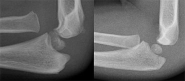 LEFT: an obvious radial dislocation. No fracture of the ulna (Monteggia) was foundRIGHT: a subtle radial head dislocation. Associated olecranonfracture is seen on carefull inspection