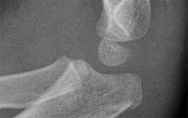 Olecranon fracture indicated by discontinuity of the dorsal cortex. No associated fracture.