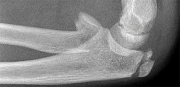Normal olecranon ossification centres in a patient with a tilted radial neck fracture.