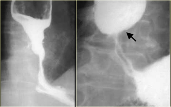 LEFT: Long irregular distal stricture due to carcinomaRIGHT: Distal narrowing is not tapered and more proximal than achalasia. Irregularity (arrow) at narrowed site is subtle but persistent