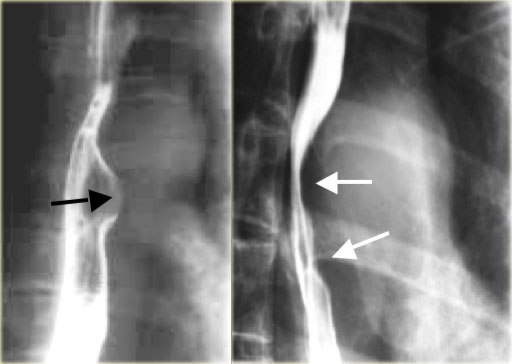 LEFT: normal esophagusRIGHT: Mediastinal nodes (arrows) displace esophagus to right