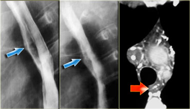 Downhill varices in a patient with a superior vena cava obstruction
