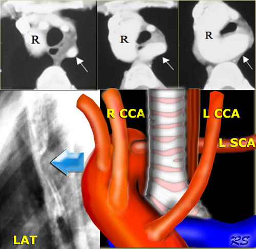 Right aortic arch with aberrant left subclavian artery