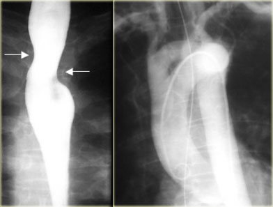 Double ArchLEFT: Right and left arch indent esophagus (arrows) at  different levels RIGHT: Angiogram with double arch in asymptomatic 65-year-old