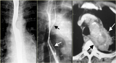 Normal and abnormal aortic arch impression on the esophagus