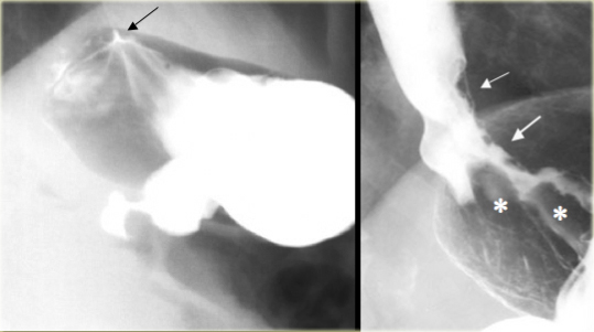 Normal gastroesophageal junction (left), Fundal adenocarcinoma invades  esophagus (right)