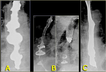 A. Initial nonpropulsive tertiary contractions  B. Three images during examination show collections resembling diverticula                                   C. Image later in examination shows resolution of tertiary contractions