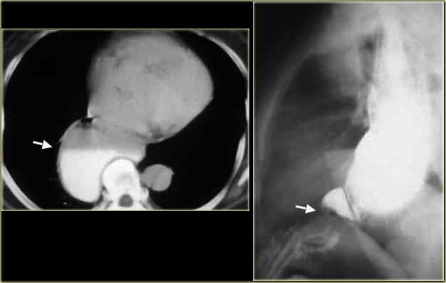LEFT: CT shows dilated esophagus (arrow) that led to esophagram.RIGHT: Esophagram shows narrowing (arrow) at level of hiatus.