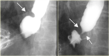 Esophageal A-ring due to muscular contraction. It varies during examination and may not persist.