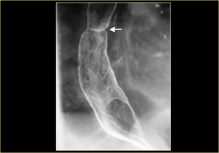 Barrett's esophagus with reticular mucosa and  web-like (arrow) stricture