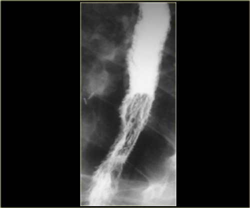 View of Boerhaave's syndrome as an initial presentation of eosinophilic  esophagitis: a case series | Annals of Gastroenterology