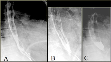 Feline esophagus: A, B: Show fine horizontal esophageal folds; C: Later image during study no longer shows folds