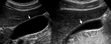 LEFT: US of a normal gallbladder after an overnight fast shows the wall as a pencil-thin echogenic line (arrow).RIGHT: US in the postprandial state shows pseudothickening of the gallbladder