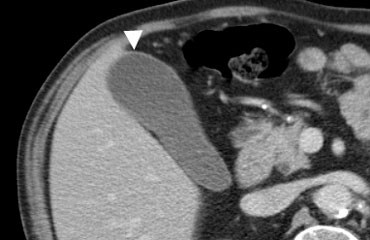 Contrast-enhanced CT shows the normal gallbladder wall as a thin rim of enhancing soft-tissue