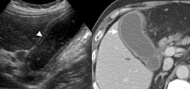 LEFT: US in a 59-year-old woman with acute cholecystitis shows the layered appearance of a thickened gallbladder wall, with a hypoechoic region between echogenic linesRIGHT: At contrast-enhanced CT the thick-walled gallbladder contains a hypodense outer layer (arrow) due to subserosal oedema