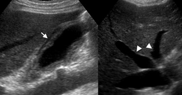Diffuse gallbladder wall thickening in congestive right heart failure