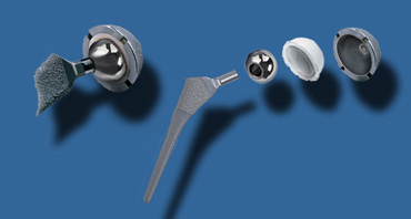 LEFT: Assembled cementless Mallory Head prosthesis.RIGHT: Femoral stem with proximal porous coating for bone ingrowth, separate metal femoral head,  polyethylene acetabular liner with a porous coated metal backing.