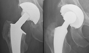 LEFT: Hybrid THA with cemented femoral stem and noncemented acetabular cup.RIGHT: Bone ingrowth arthroplasty. Density lateral to femoral stem in Gruens zone I is a bone graft.