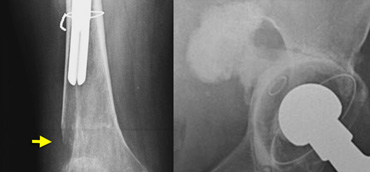 LEFT: Revision THA with a large femoral stem with periprosthetic fracture.RIGHT: Cement extrusion intrapelvic through acetabular defect.