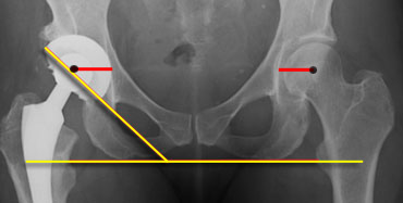 Measurement of lateral acetabular inclination. Right trochanter minor is lower in position than the left indicating leg length dicrepancy.Normal horizontal center of rotation (red line).