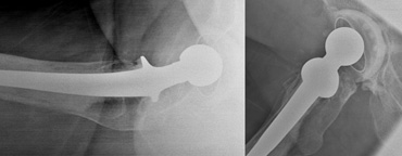 Different anteversion of the acetabular cup in the same patient due to different rotation on a cross table view (left) compared to a lateral view (right).