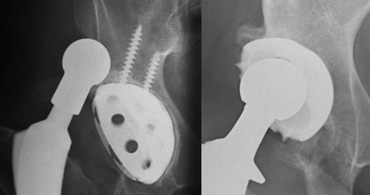 LEFT: Femoral head with large collar. Dislocation due to increased lateral inclination of acetabular cupRIGHT: Different patient at risk for dislocation. High and lateral position of a steep acetabular cup. Notice polyethylene wear due to increased forces on the superolateral side of the cup.