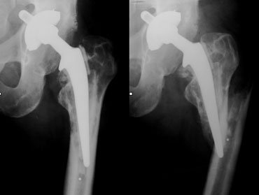 Varus position of femoral stem leading to loosening and fracture.
