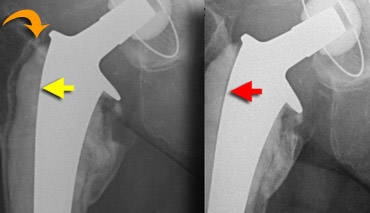 LEFT: Normal cement-metal interface (yellow arrow). However loosening at cement-bone interface (orange curved arrow).RIGHT: At follow up also loosening at cement-metal interface.