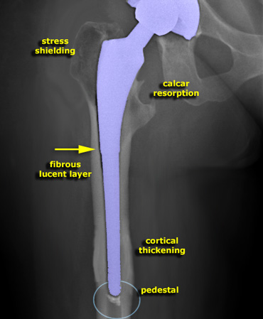 Manipulated image showing normal reactions to the some of the uncemented hip prostheses.