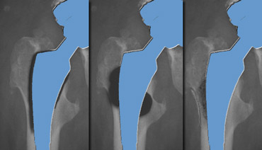 Illustration of the typical radiographic changes in Loosening (left) - Particle disease (middle) - Infection (right)
