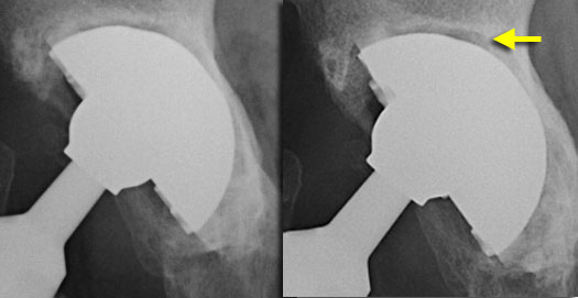 Progressive lucent zone around acetabular component in zone I and II.  Steeper position of the cup indicates migration. Subtle excentric positioning of the femoral head is indicative of polyethylene wear.