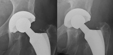 Migration of acetabular cup cranially with tilting and subsequent acetabular fracture