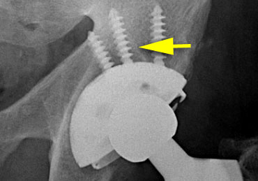 Subtle eccentric position of femoral head. Even more subtle focal osteolysis around screw in acetabulum.