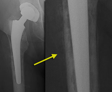 Irregular periprosthetic bone resorption with periosteal reaction typical for infection.