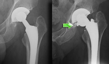 Total hip replacement, Radiology Case