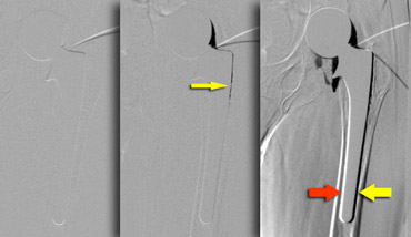 Subtraction arthrography reveals contrast leakage in Gruen zone 1 (yellow arrow).Movement of the patient simulates leakage in zone 2 and 3 (red arrow indicates white stripe on medial side which is as broad as black stripe on lateral side ( yellow arrow).