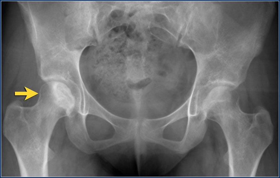 xray hip normal vs abnormal
