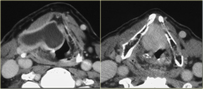 Secondary internal and external laryngocele caused by a tumor at the level of the laryngeal ventricle ( enhancing mass on the right image)