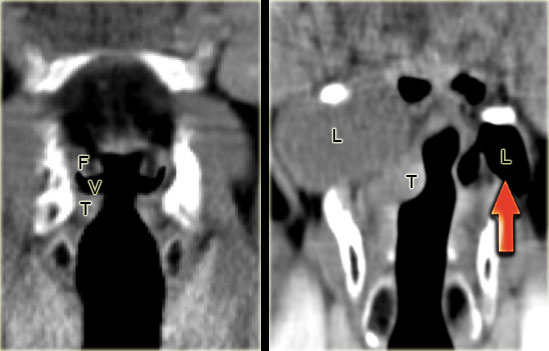 LEFT: Coronal CT image through the larynx with normal anatomy: false cords (F), true cords (T) and ventricle in between (V) RIGHT:Fluid-filled secondary internal and external laryngocele due to a small enhancing tumor in the laryngeal ventricle (T) obstructing the laryngeal ventricle. On the left side, an air-filled primary internal and external laryngocele.
