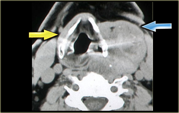 Multinodular goiter Strap muscles on right side (yellow arrow) and presumed position of strap muscles on the left (blue arrow)